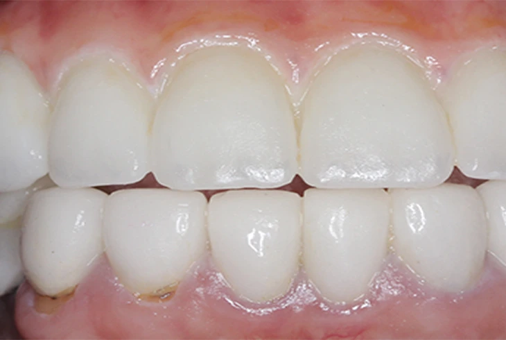 Zygomatic 1 A